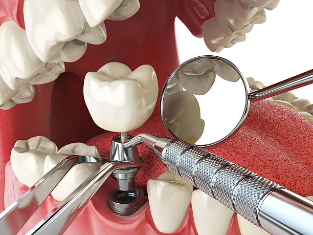 Best Emergency Root Canal Treatment in Lookout Mountain, GA